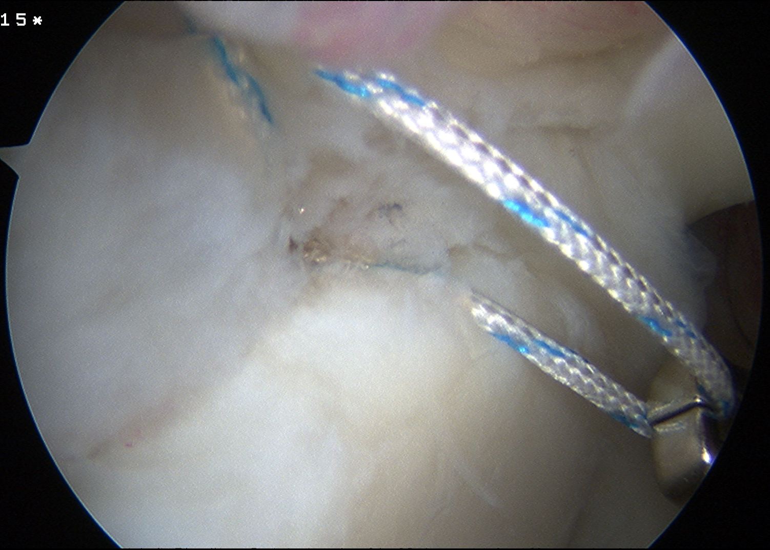 SLAP Posterior Sutures